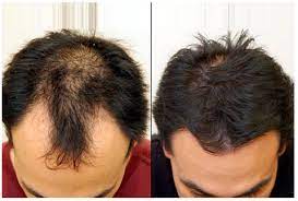 Low Level Laser Therapy Hair Growth Reviews 2021