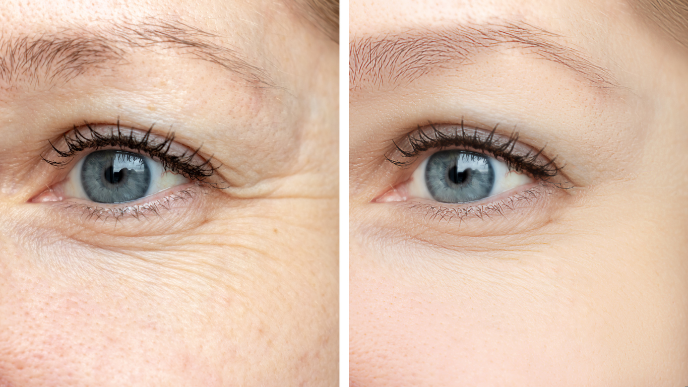 10 Best Laser For Under Eye Wrinkles 2023 - Buyer's Guide