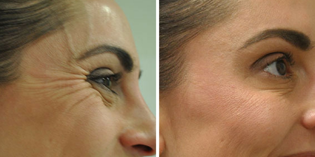 Best-Laser-Treatment-For-Under-Eye-Wrinkles