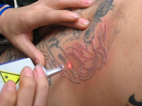 Best-Tattoo-Removal-Laser-Treatment