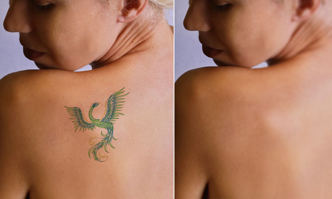 Laser-Away-Tattoo-Removal-Reviews