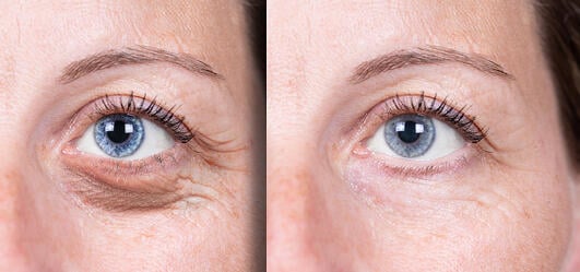 10 Best Laser For Eye Wrinkles 2023 - Buyer's Guide
